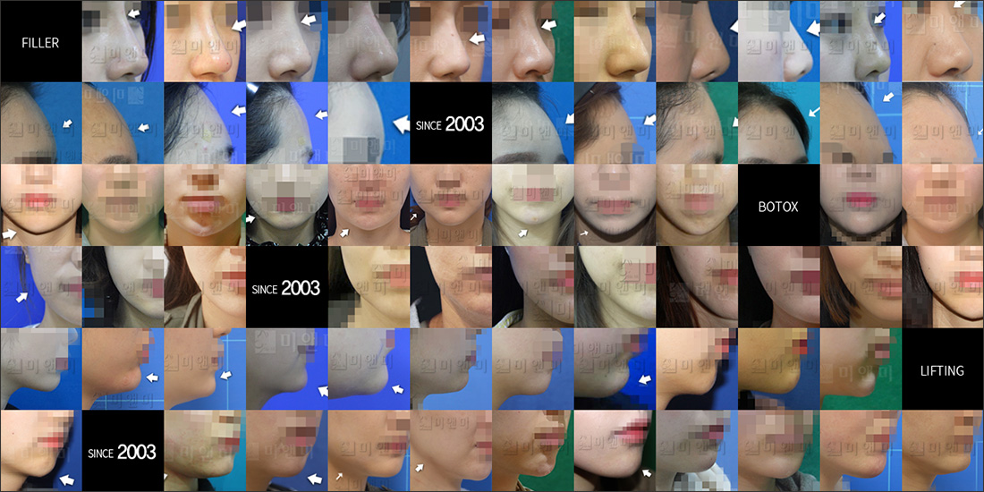 SINCE 2003 MI&MI, 시술후사진모음 천안코필러, 신부동코필러