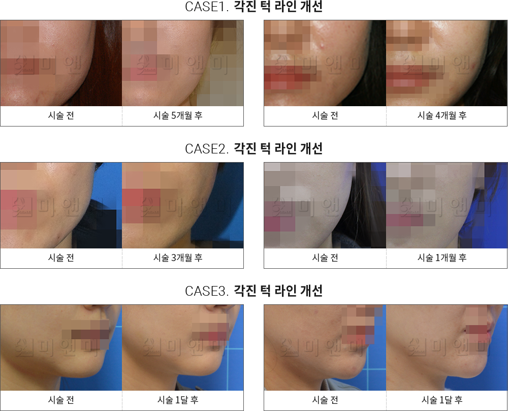시술전후사진 사각턱 보톡스 : 각진 턱 라인 개선 천안사각턱보톡스, 신부동사각턱보톡스