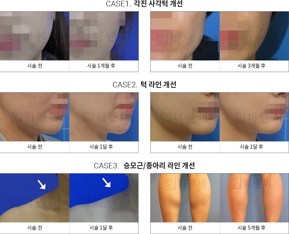 시술전후사진 승모근 보톡스 : 각진 사각턱 개선,턱 라인 개선,승모근/종아리 라인 개선 천안승모근보톡스, 신부동승모근보톡스