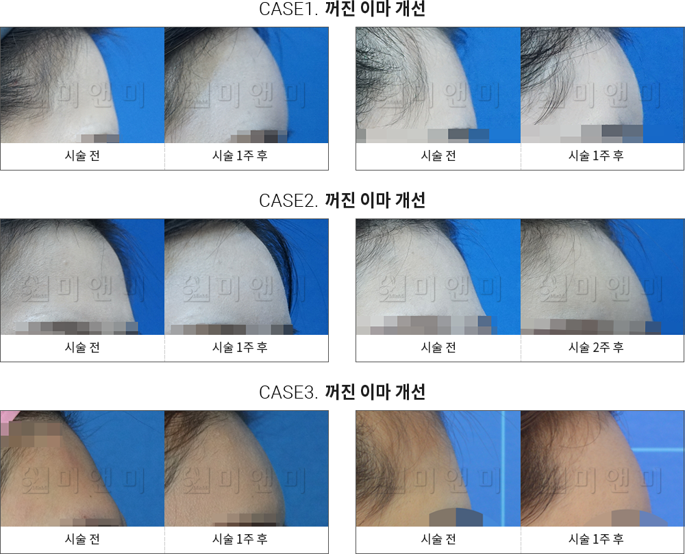 시술전후사진 이마필러 : 무턱개선 천안이마필러, 신부동이마필러