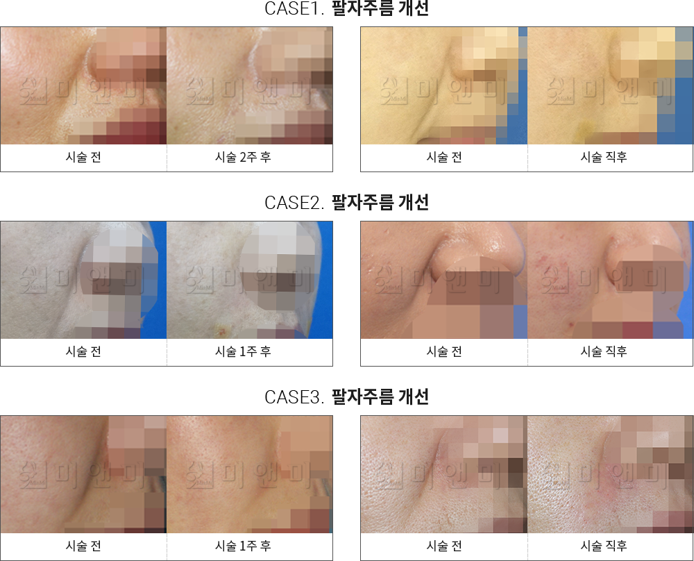 시술전후사진 팔자필러 : 팔자주름 개선 천안팔자필러, 신부동팔자필러